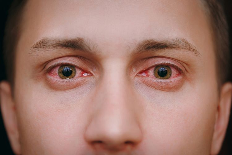 Zarudlé oči jako důsledek alergie