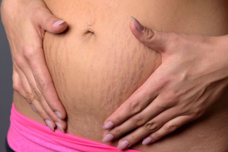 Strie na břiše po těhotenství