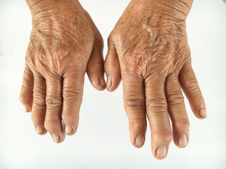 Deformování rukou kvůli revmatismu