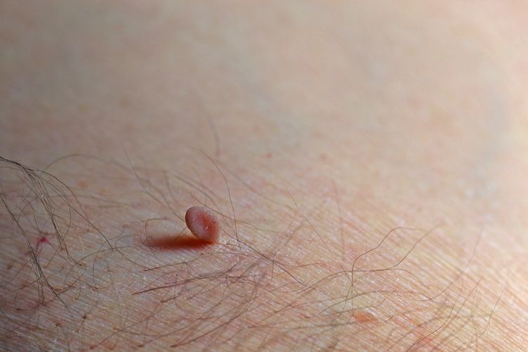 Kožní výrůstek - fibrom na kůži