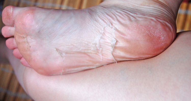 Olupování kůže na nohou po exfoliaci