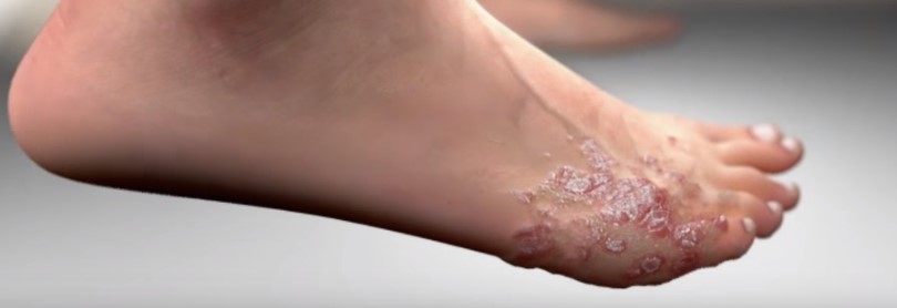 Psoriasis arthritis zvenčí