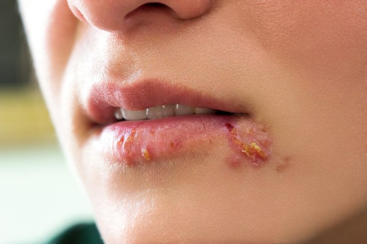 Žena s bolestivým herpesem na rtu a v koutku úst