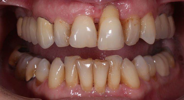 Zuby postižené paradentózou