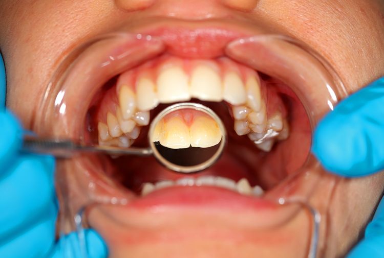 Kontrola zubního kamene na zubní prohlídce