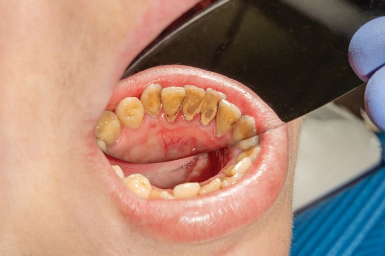 Zuby se zubním kamenem