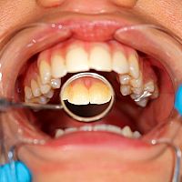 Co na zubní kámen? Pasta, škrabka i dentální párátka