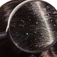 Nejlepší šampon proti lupům z lékárny? Poradí test a recenze