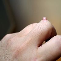 Jak odstranit bradavice na obličeji, krku, ale i noze? Domácí léčbu nabízí lékárna