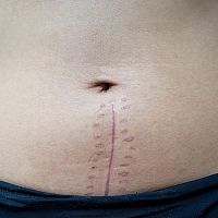 Nejlepší krém na jizvy po operaci? Masti na hojení jizev, které fungují