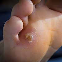 Jak se zbavit kuřího oka? Vyzkoušejte náplasti nebo polštářek na kuří oko