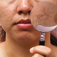 Krémy na pigmentové skvrny na obličeji jako účinná léčba. Pomáhá i citron.