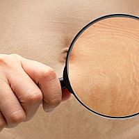 Strie na prsou, bocích a nohách po porodu – jak se jich zbavit? Pomáhají krémy?