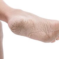 Suché a popraskané paty – příčiny a léčba