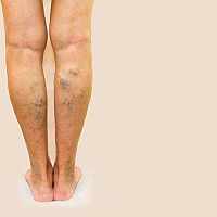 Krémy a léky na křečové žíly na nohou. Domácí léčba funguje