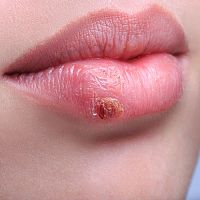 Herpes na rtech? Zubní pasta jako účinná domácí léčba